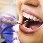 Un zâmbet frumos și aliniat nu doar că arată bine, dar are și beneficii semnificative pentru sănătatea dentară și starea generală de bine.