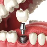 Dinții lipsă pot afecta nu doar aspectul estetic al zâmbetului, ci și funcționalitatea și sănătatea generală a cavității bucale.