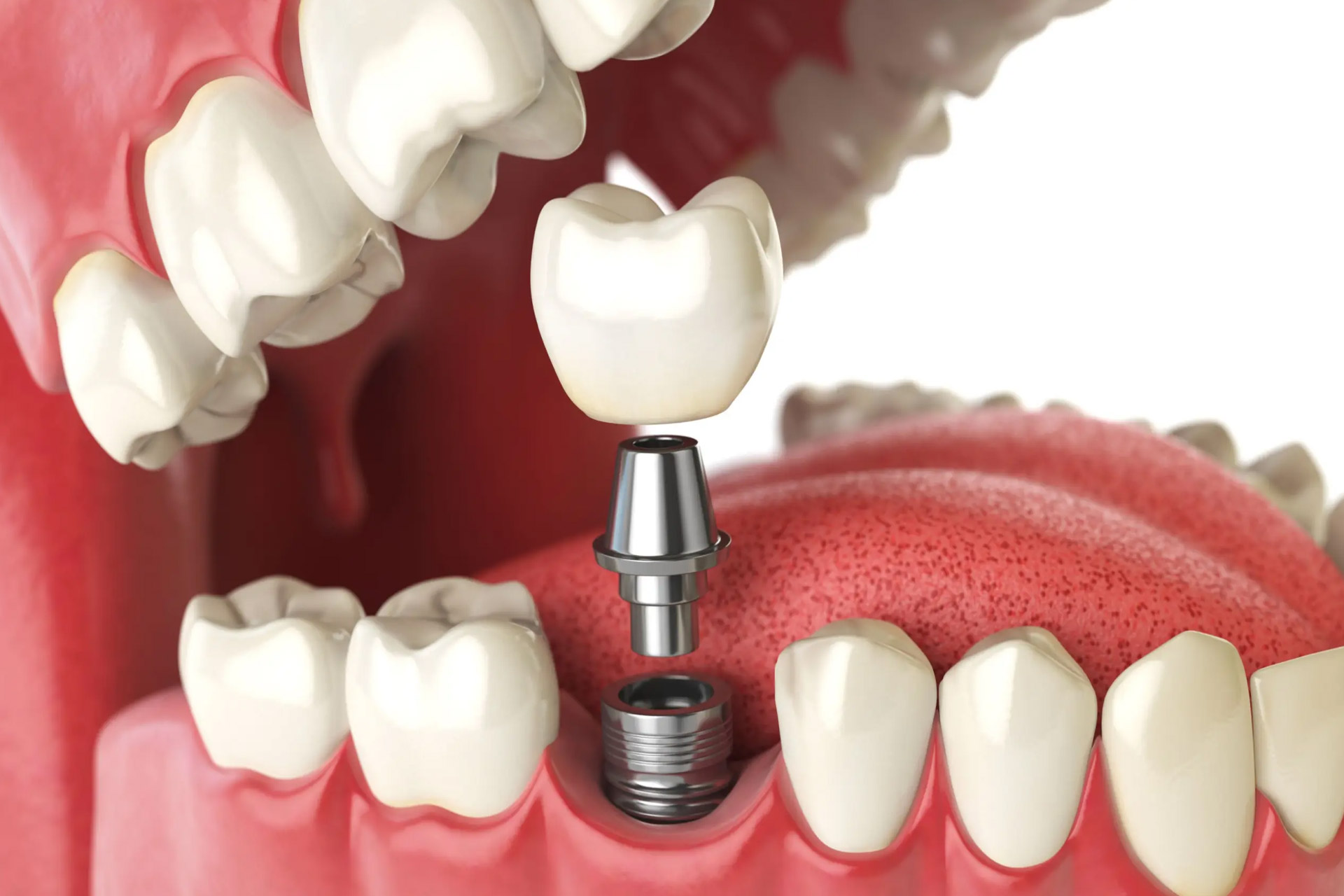 Dinții lipsă pot afecta nu doar aspectul estetic al zâmbetului, ci și funcționalitatea și sănătatea generală a cavității bucale.
